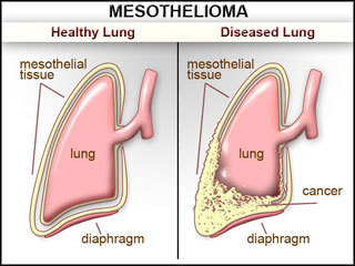 How do I know if i have mesothelioma